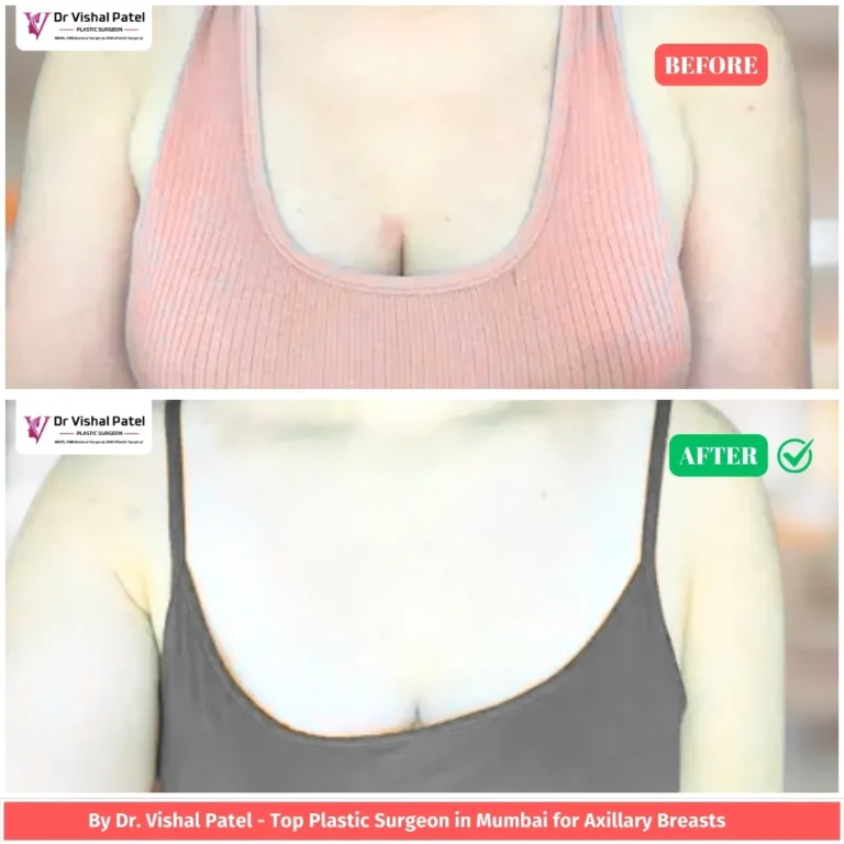 2 Sided Axillary breast tissue removal surgery in Mumbai - Before & After