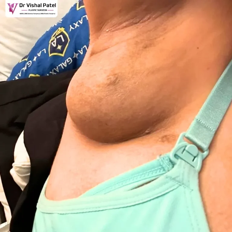 Accessory Breast in Indian Women in Mumbai