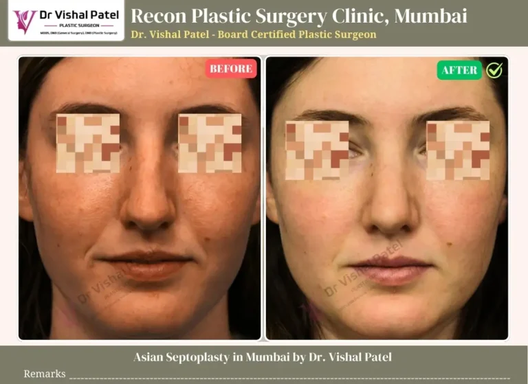 Asian Septoplasty in Mumbai - Before and After Photo by Dr. Vishal Patel