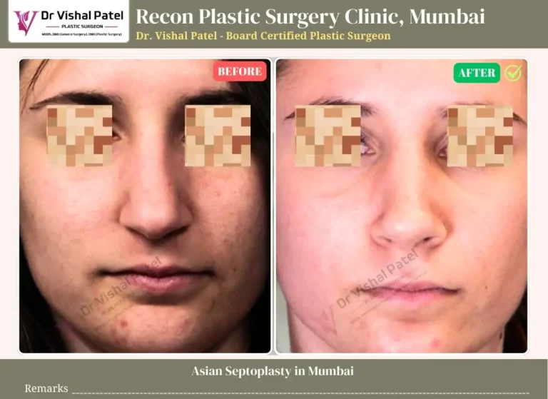 Asian Septoplasty in Mumbai - Surgery by Dr. Vishal Patel