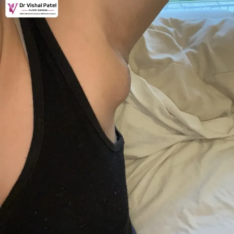 Axillary Breast in Indian Women in Mumbai