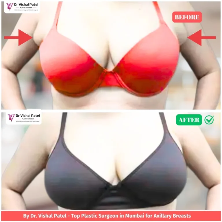 Axillary breast tissue removal surgery in Mumbai - Before & After