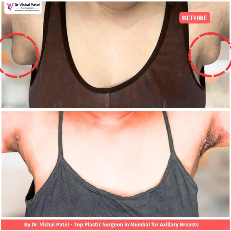 Bilateral Axillary breast tissue removal surgery in Mumbai - Before & After