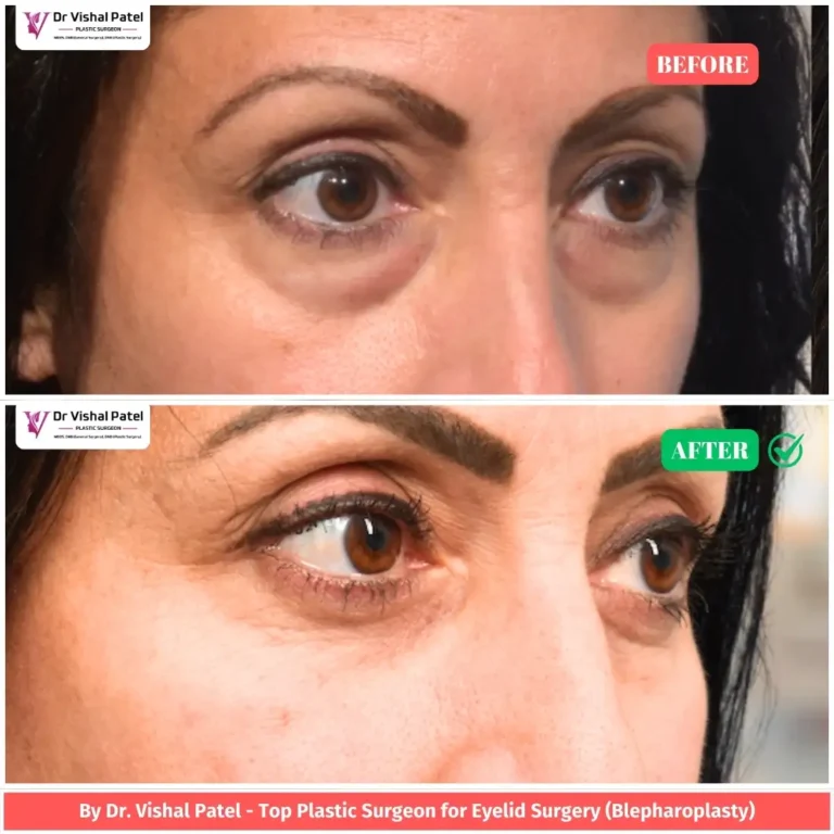 Bilateral blepharoplasty in Mumbai India Before After Photo - Indian Female