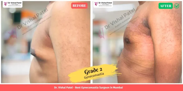 Grade 2 Gynecomastia Before & After Photo in Mumbai - Left Side Chest View