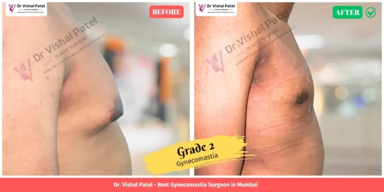 Grade 2 Gynecomastia Before & After Photo in Mumbai - Right Side Chest View
