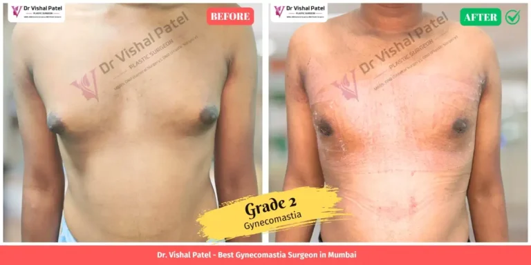 Grade 2 Gynecomastia Before & After Photo in Mumbai - Surgery by Dr. Vishal Patel