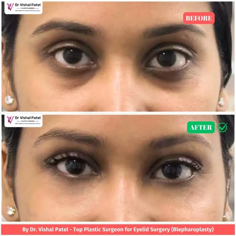 Lower Blepharoplasty Surgery in India Before & After Photo - by Dr. Vishal Patel