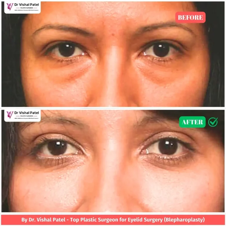 Lower Blepharoplasty in Mumbai Malad by Dr. Vishal Patel - Indian Female