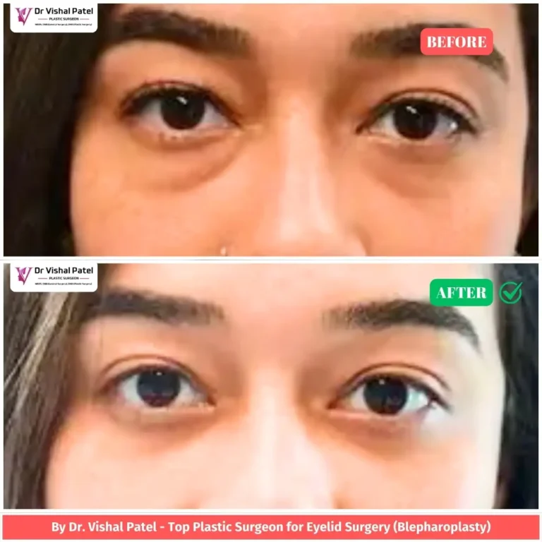 Lower Eyelid Surgery Before & After Photo - by Dr. Vishal Patel