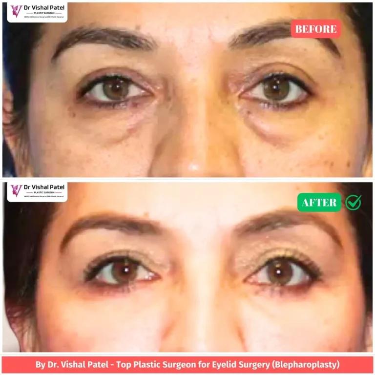Lower Eyelid Surgery in Mumbai by Dr. Vishal Patel in Malad - Indian Women