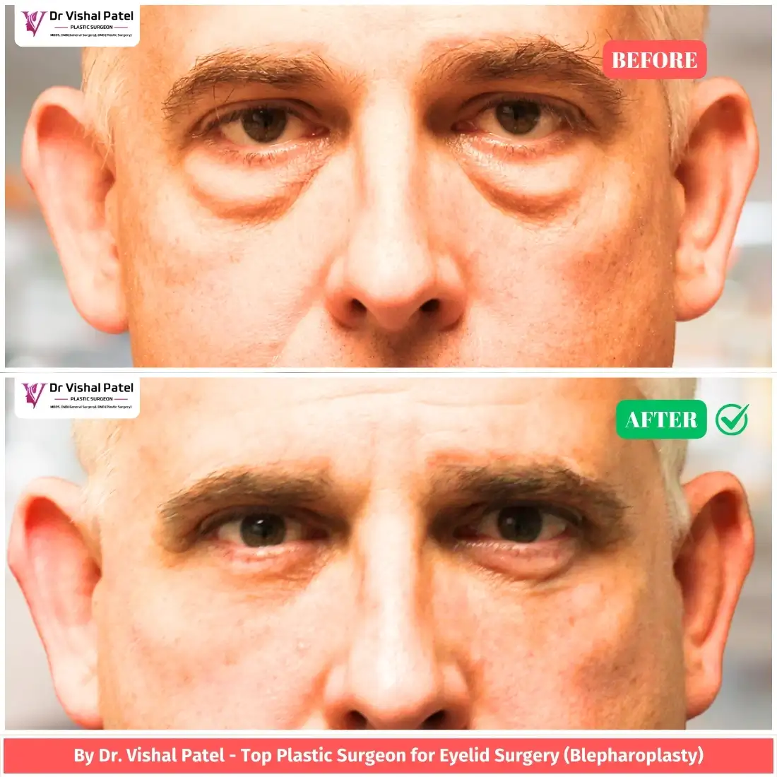 Lower blepharoplasty in Mumbai Before & After Photo