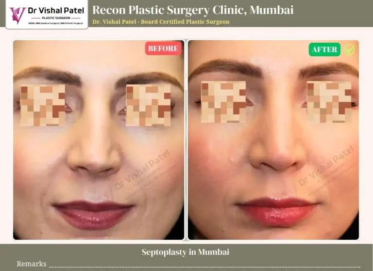 Septoplasty Before and After Photo by Dr. Vishal Patel in Mumbai
