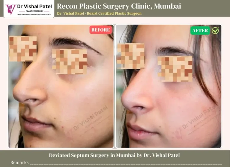 Septoplasty Before and After Surgery Photo in Mumbai - Indian Female