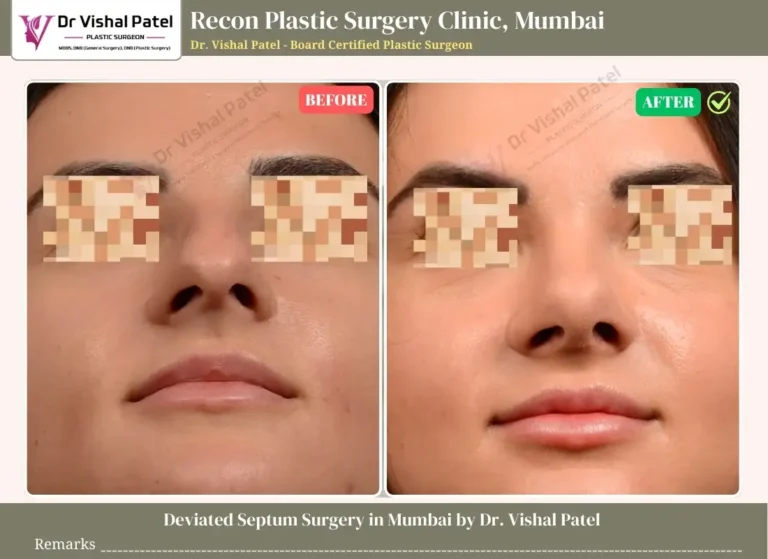 Septoplasty Before and After Surgery Photo in Mumbai - Indian Male