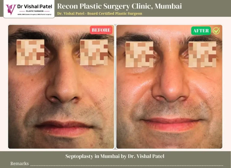 Septoplasty Indian Men - Before and After Photo by Dr. Vishal Patel in Mumbai