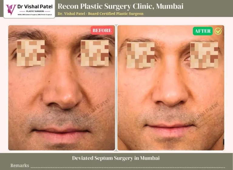 Septoplasty Male Mumbai - Before and After Photo by Dr. Vishal Patel in Mumbai