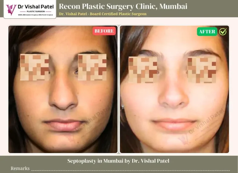 Septoplasty Surgery in Mumbai - Female in Mumbai - Before After Photo