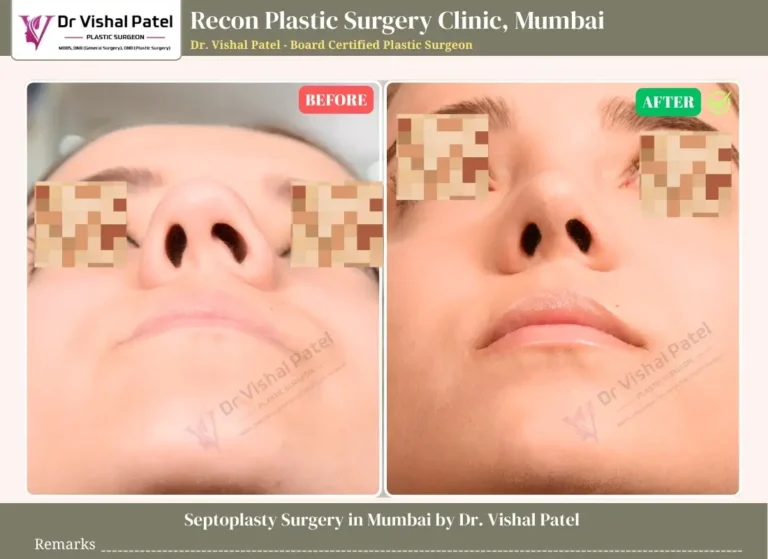 Septoplasty Surgery in Mumbai - Indian Female Before After Photo
