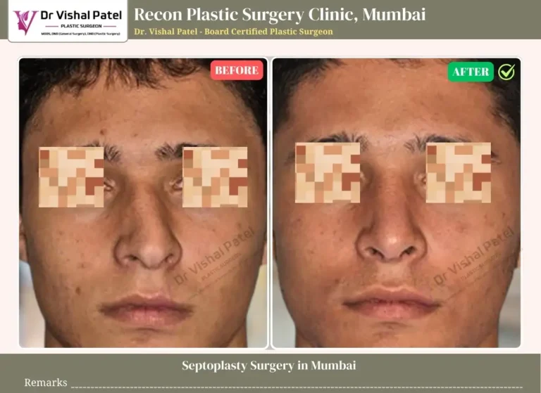 Septoplasty Surgery in Mumbai by Dr. Vishal Patel - Before After Septoplasty Photo