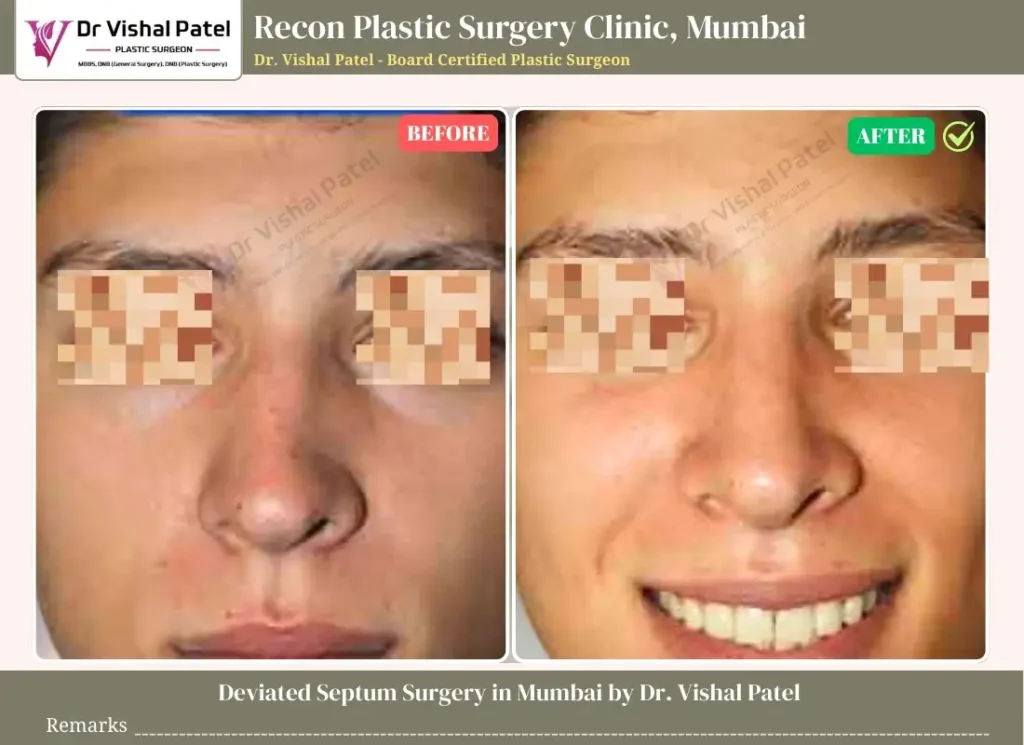 Septoplasty in Mumbai - Before and After Surgery Photo - Indian Male