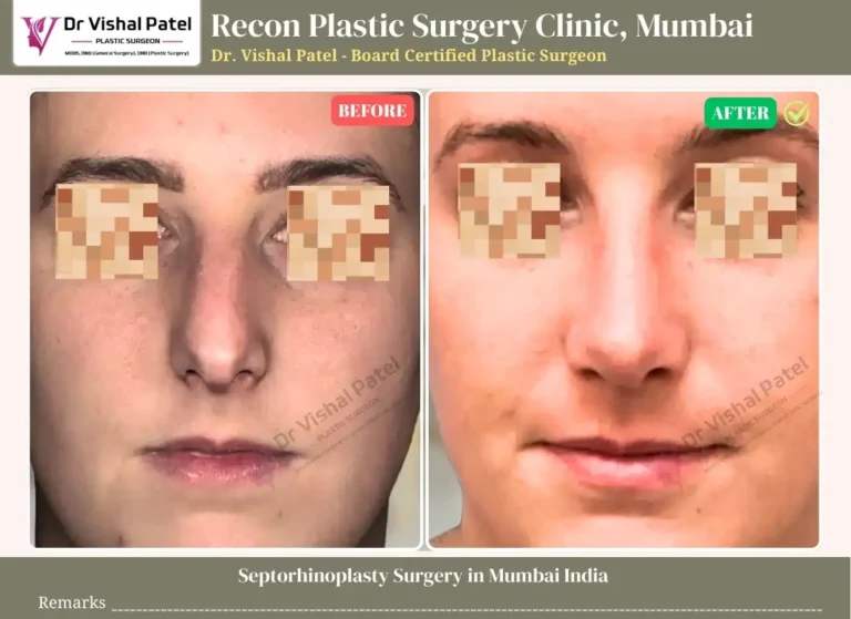 Septorhinoplasty Surgery in Mumbai India - By Dr. Vishal Patel