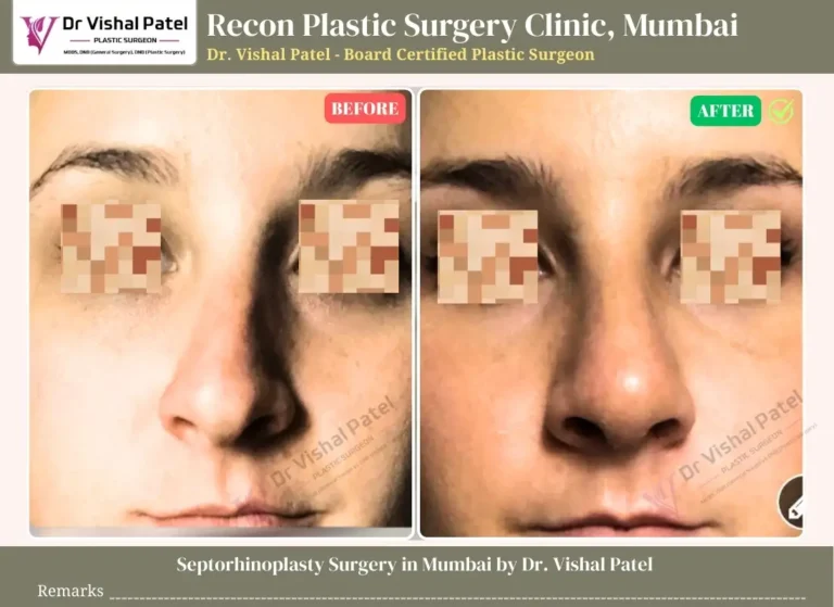 Septorhinoplasty Surgery in Mumbai by Dr. Vishal Patel - Before After Septorhinoplasty Photo