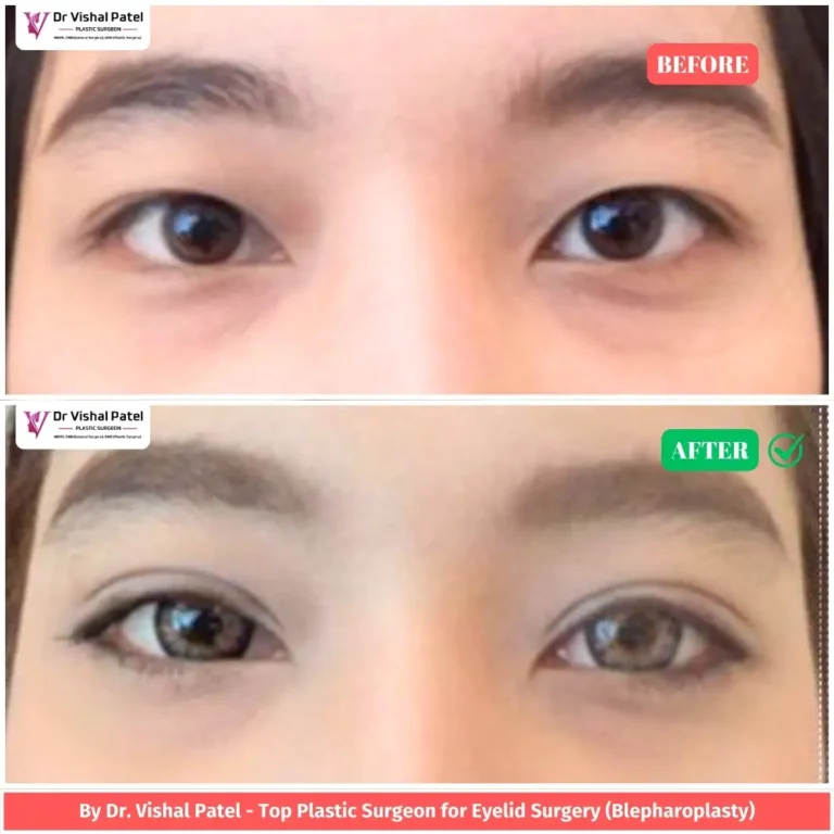 Upper Eyelid Surgery in Mumbai - Before & After Photo