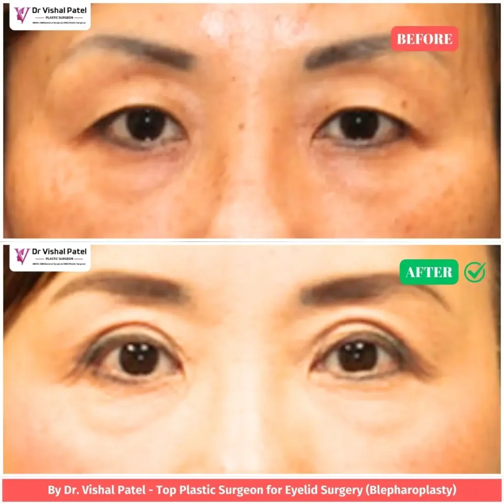 Upper blepharoplasty Indian Women Before & After