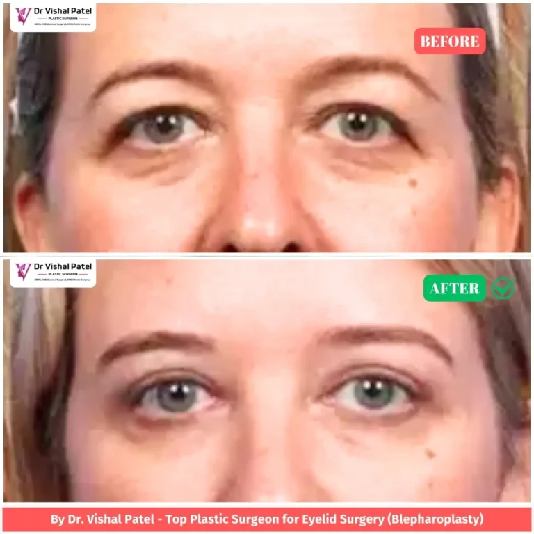 Upper blepharoplasty in Mumbai Before & After Photo