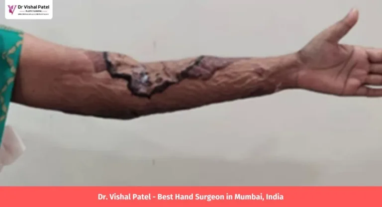 Hand after 1 week of burn surgery in Mumbai.