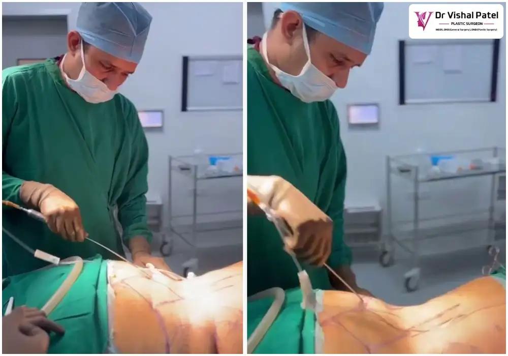 Abdomen Liposuction in Mumbai by Dr. Vishal Patel