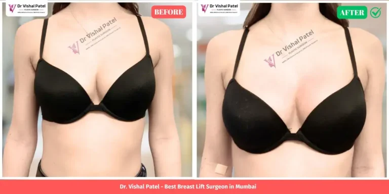 Breast lift before and after surgery in Mumbai India - By Dr. Vishal Patel