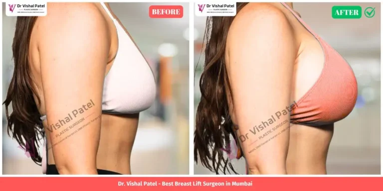 Breast lift with Breast Augmentation before and after surgery in Mumbai India - By Dr. Vishal Patel