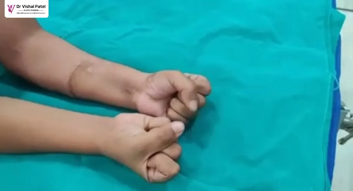 Both hands on table for comparison after hand cut surgery in Mumbai.