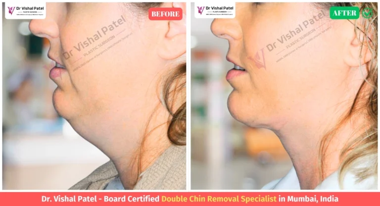 Double Chin Before and After Photo - Foreigner Patient Surgery in Mumbai India