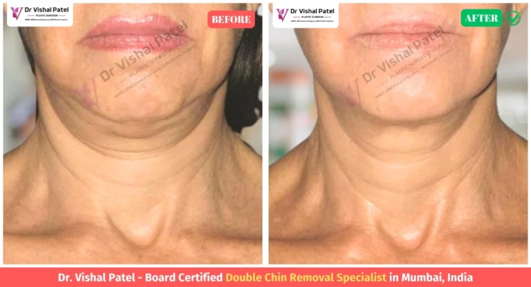 Double Chin Liposuction Before and After Photo Indian Women in Mumbai