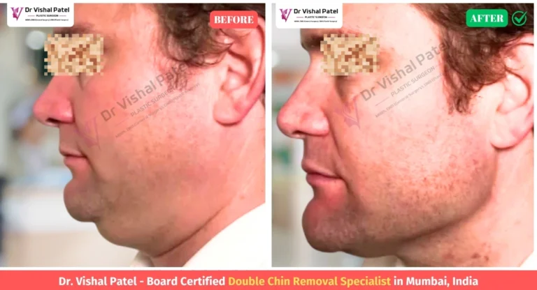Double Chin Liposuction Before and After Photo in India - Male