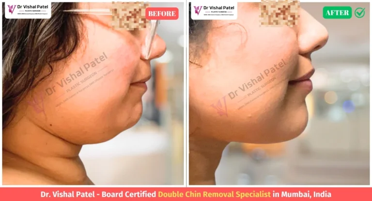 Double Chin Liposuction Surgery Before After Photo - Indian Female in Mumbai