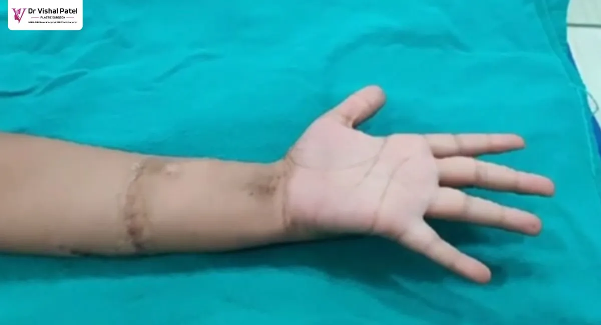 Hand examining Finger Flexors after hand cut surgery.