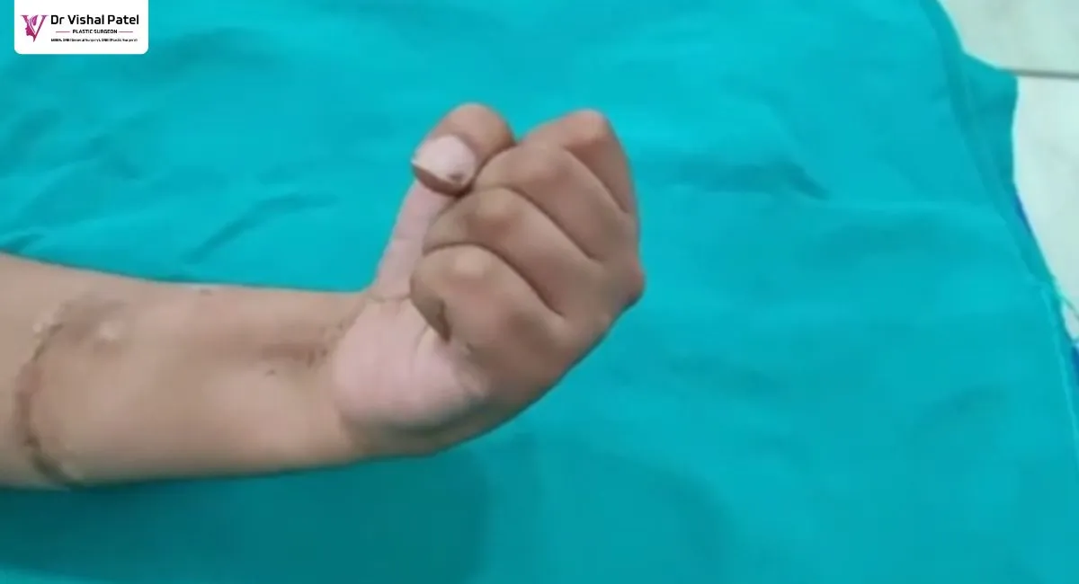 Hand showing wrist movements after hand cut surgery.