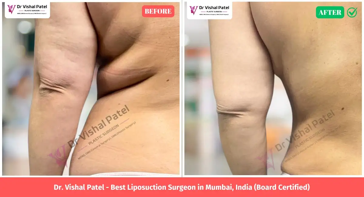 Flank Liposuction Side View Before After Photo in Mumbai India