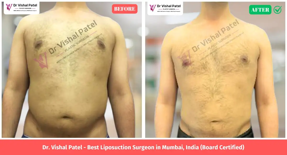Flank Liposuction in Mumbai by Dr. Vishal Patel