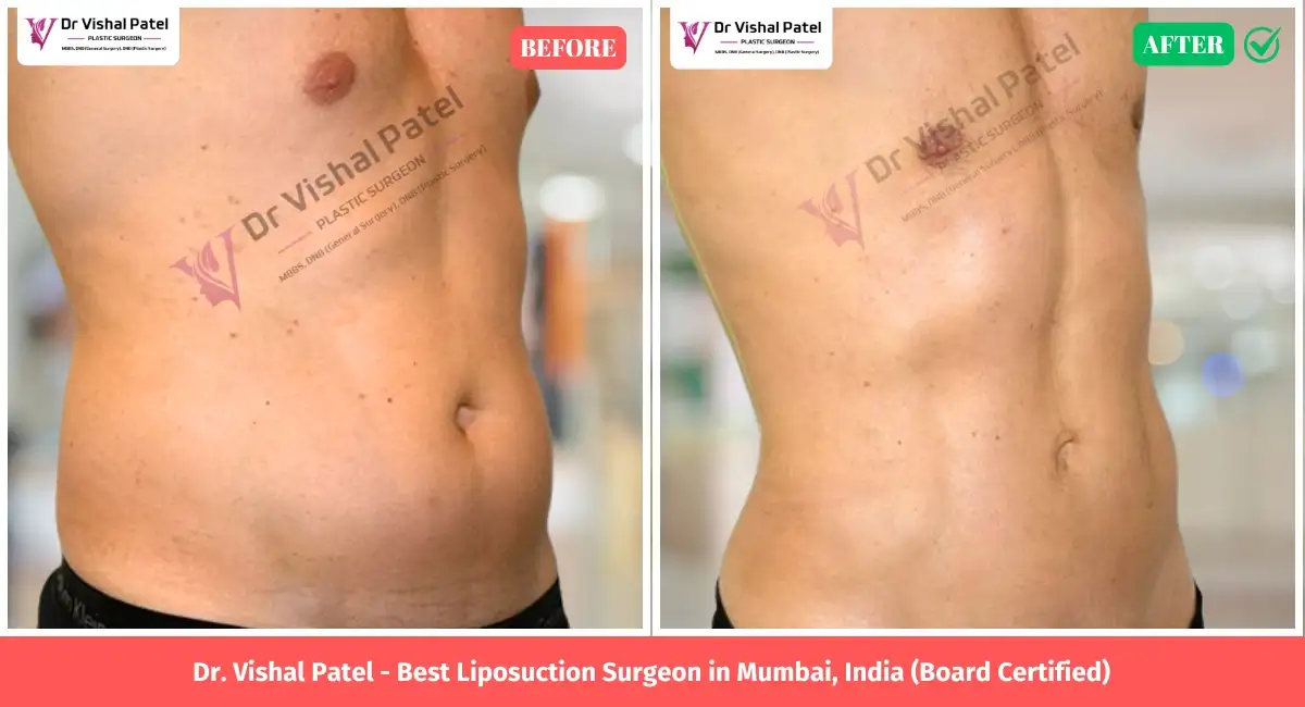 Flank liposuction Before After Picture in India by Dr. Vishal Patel