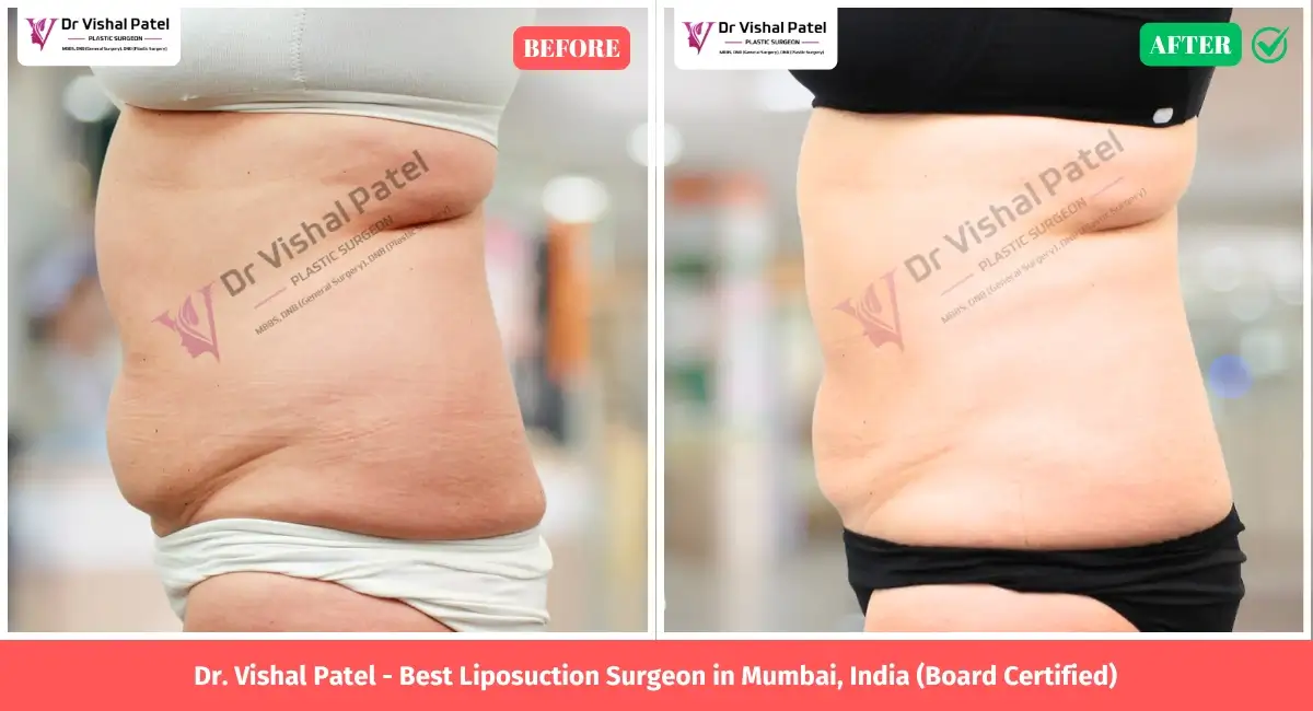 Flank liposuction in Mumbai Before and After Photo Indian Female - Surgery by Dr. Vishal Patel