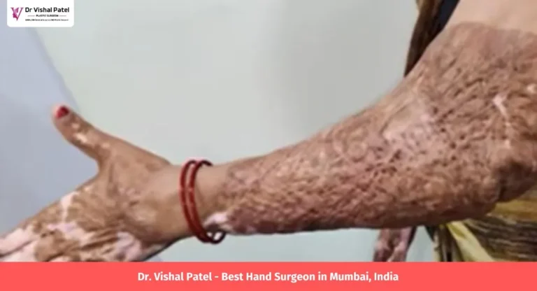 Women hand with burn scars on it after undergoing hand surgery in Mumbai.