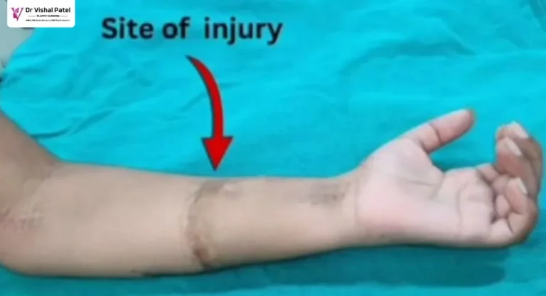 A Glass cut on mid forearm.