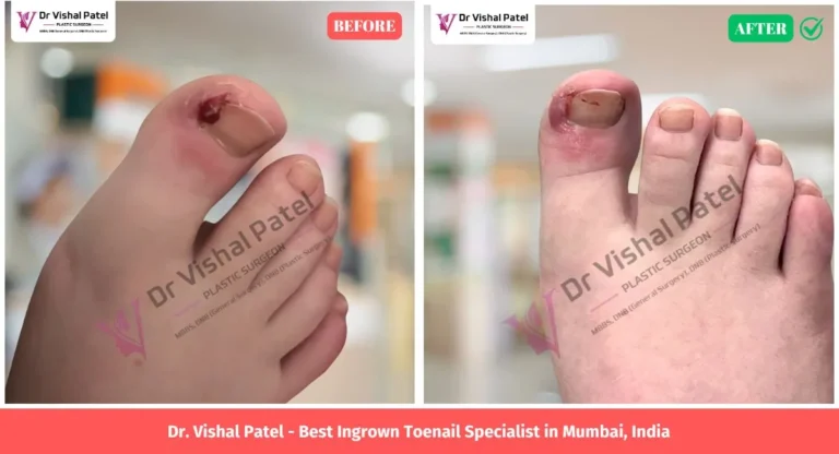 Ingrown Toenail Photos in Mumbai India - Before After Surgery