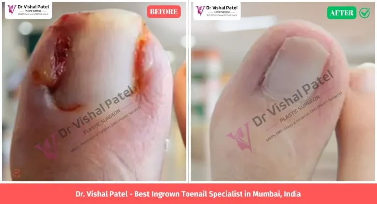 Ingrown Toenail in Mumbai India - Before After Photo