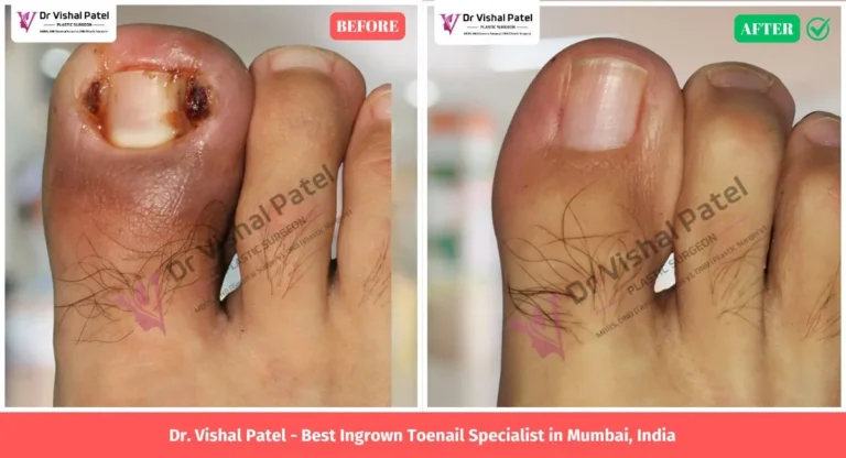 Ingrown toenail treatment in Mumbai India - Before and after photo